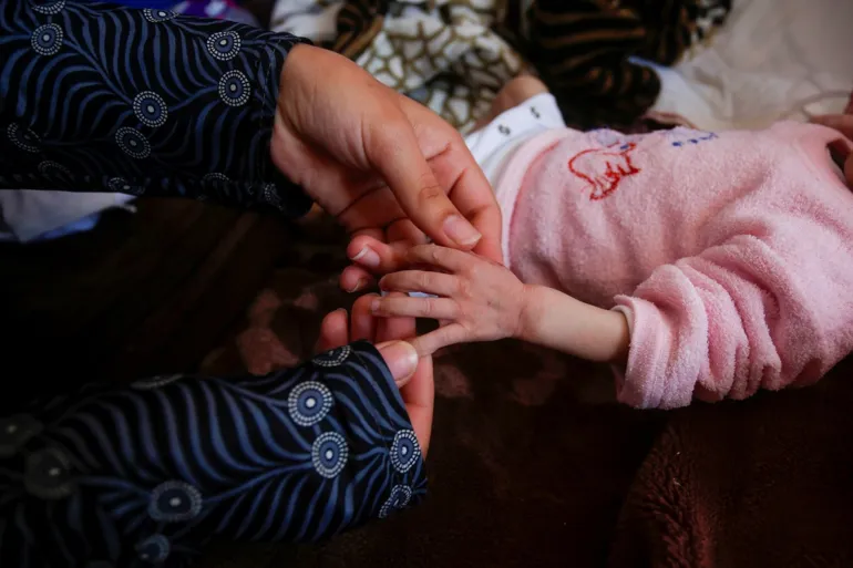 مستشفى العودة في غزة يشهد ولادة صادمة لطفلة بلا دماغ